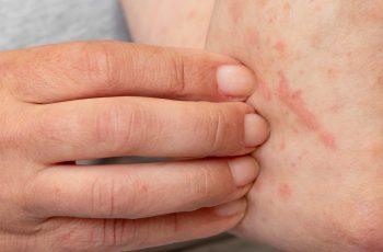 7 Excellent Home Remedies For Skin Allergy Itching