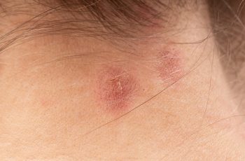 9 Highly-effective Home Remedies For Eczema